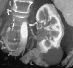 Recurrent Tumor (lymphoma) in Left Renal Pelvis - CTisus CT Scan