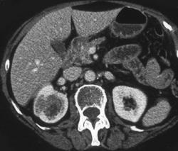 Transitional Cell Carcinoma - CTisus CT Scan