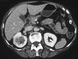 Transitional Cell Carcinoma - CTisus CT Scan