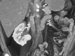 Hypervascular Renal Cell Carcinoma - CTisus CT Scan