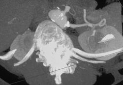 MIP Has False Renal Artery Stenosis. VRT Is Normal - CTisus CT Scan