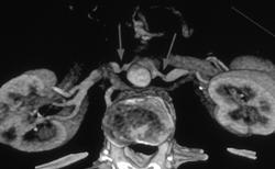 Renal Artery Stenosis - CTisus CT Scan