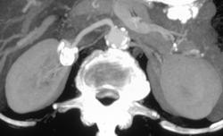 Right Renal Artery Aneurysm - CTisus CT Scan