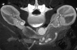 Right and Left Renal Artery Aneurysms - CTisus CT Scan