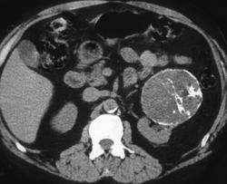 Renal Cell Carcinoma - CTisus CT Scan