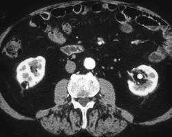 Right Renal Angiomyolipoma - CTisus CT Scan