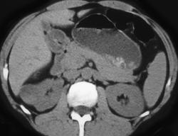 Hypervascular Renal Cell Carcinoma - CTisus CT Scan