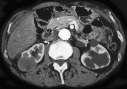 Renal Cell Carcinoma - CTisus CT Scan