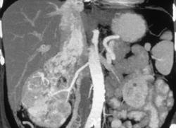 Hypervascular Right Renal Cell Carcinoma Invades Inferior Vena Cava (IVC) - CTisus CT Scan