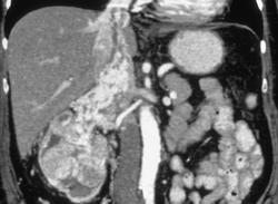 Renal Cell Invades Inferior Vena Cava (IVC) - CTisus CT Scan