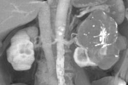 Renal Cell Carcinoma - CTisus CT Scan