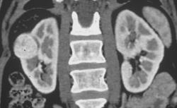 Hypervascular Right Renal Cell Carcinoma - CTisus CT Scan