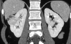 Late Phase Renal Cell Carcinoma - CTisus CT Scan