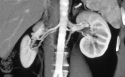 Retroaortic Left Renal Vein - CTisus CT Scan