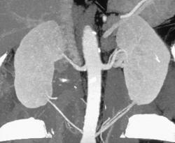 Accessory Renal Arteries to Lower Pole of Kidneys From Low Origins - CTisus CT Scan