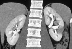 Focal Renal Abscesses - CTisus CT Scan