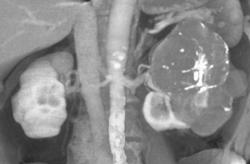 Renal Cell Carcinoma - CTisus CT Scan