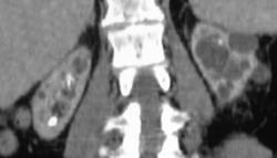 End Stage Kidney Disease (chronic Pyelonephritis) - CTisus CT Scan