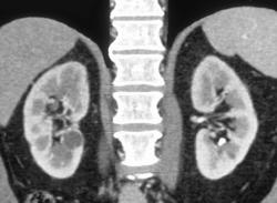 Left Renal Calculi - CTisus CT Scan