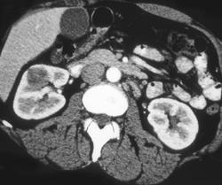 Oncocytoma - CTisus CT Scan