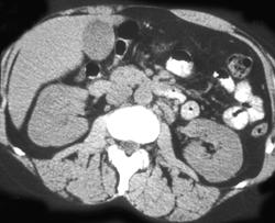 Oncocytoma - CTisus CT Scan