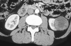 Renal Cell Cancer - CTisus CT Scan