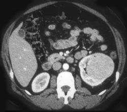 Oncocytoma - CTisus CT Scan