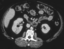 Hypervascular Renal Cell Cancer in Right Kidney - CTisus CT Scan