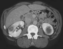 Bilateral Renal Metastases From Lung Cancer - CTisus CT Scan