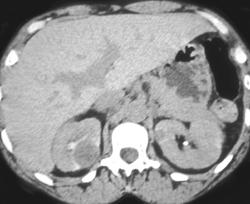 Bilateral Renal Abscesses - CTisus CT Scan