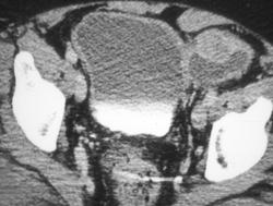 Bladder Cancer in A Diverticula - CTisus CT Scan