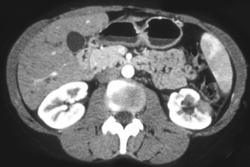 Healing Left Renal Abscess - CTisus CT Scan