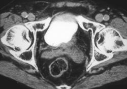 Bladder Cancer Obstructs the Left Ureter - CTisus CT Scan