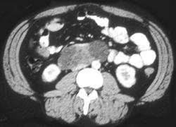 Testicular Cancer - CTisus CT Scan