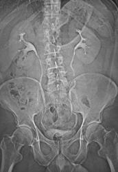 Post CT Angio Topograms for Calyceal Anatomy - CTisus CT Scan