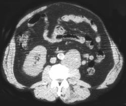 Recurrent Renal Cell Carcinoma in Nephrectomy Bed - CTisus CT Scan