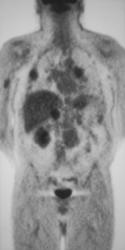 Bone Mets From Recurrent Renal Cell Carcinoma - CTisus CT Scan