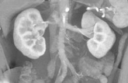 Normal 3D of Renal Arteries - CTisus CT Scan