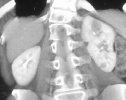 Focal Pyelonephritis - CTisus CT Scan