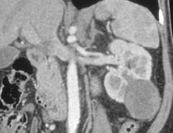 Renal Carcinoma - CTisus CT Scan