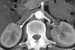 Normal Renal Arteries - CTisus CT Scan