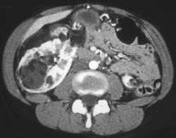 Renal Angiomyolipoma (bilateral) - CTisus CT Scan