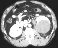 Renal Cancer Simulated An Abscess - CTisus CT Scan