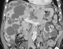 Polycystic Liver and Renal Disease - CTisus CT Scan