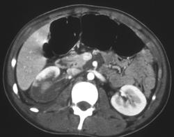 Renal Infarct - CTisus CT Scan