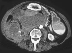 Perirenal and Pararenal Hematoma S/P Biopsy - CTisus CT Scan