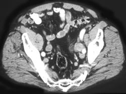 Bladder Cancer With Left Obturator Nodes - CTisus CT Scan