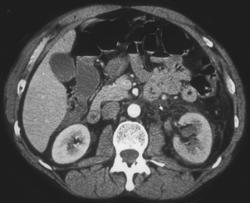 Changes Following Radiofrequency Ablation (RFA) of Renal Tumors - CTisus CT Scan