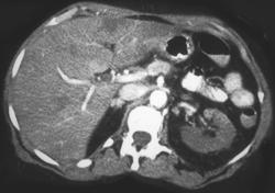 Infarcted Kidneys - CTisus CT Scan