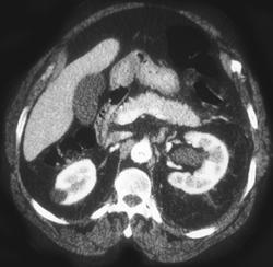 Obstructed Left Renal Pelvis By A Stone - CTisus CT Scan